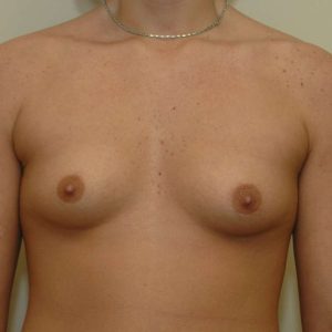 an image of a breast before undergoing a breast surgery at The Kole Plastic Surgery Center