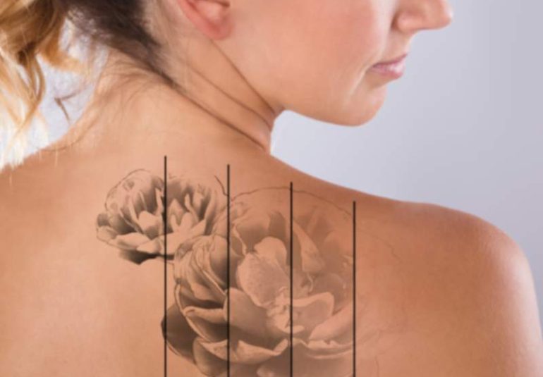 Tattoo Removal Info Kole Plastic Surgery Bucks County PA