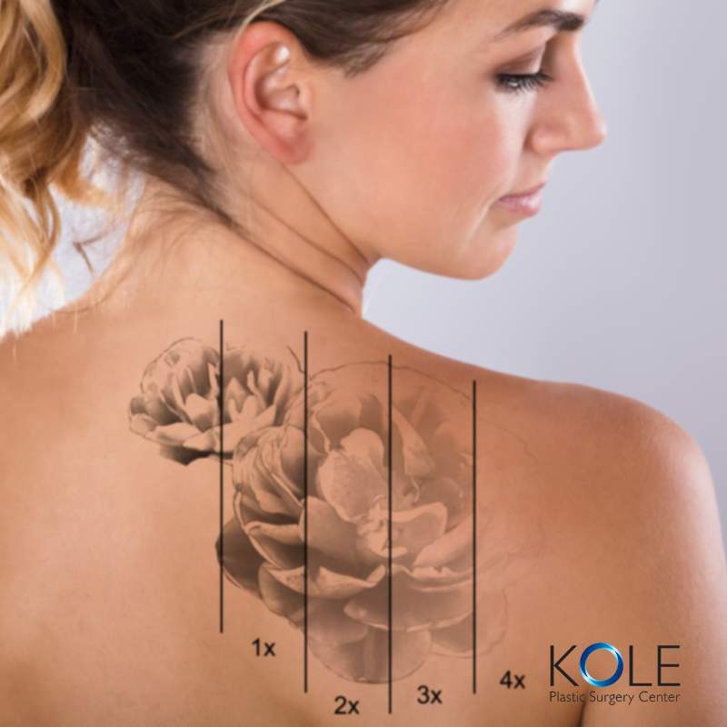 Tattoo Removal Info Kole Plastic Surgery Bucks County PA