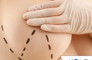 Breast lift