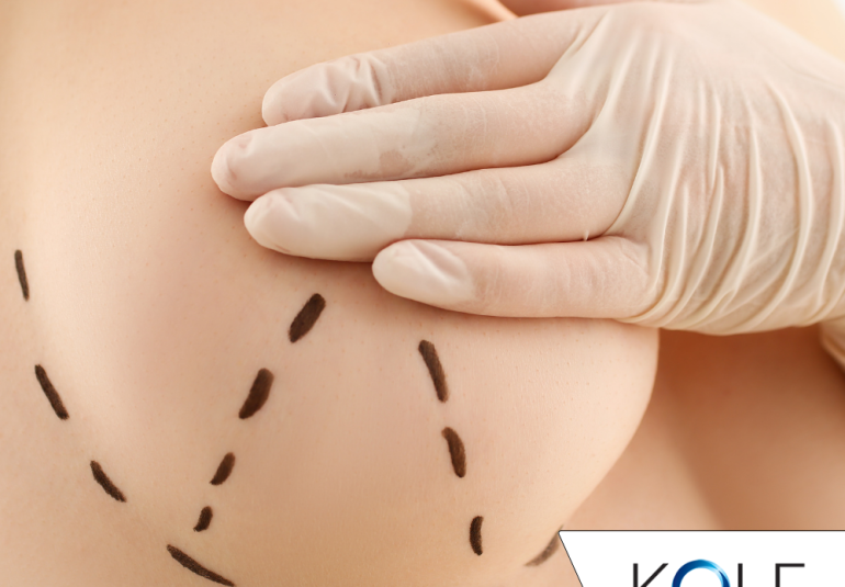 Breast lift