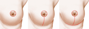 breast circumarelolar