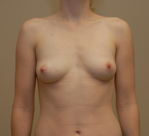 an image of breast before breast augmentation procedure