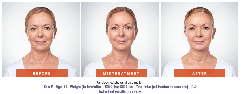 Kybella - before and after photos