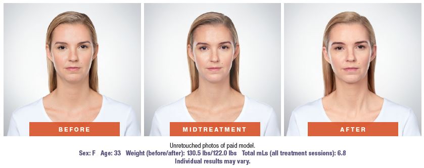 Kybella - before and after photos