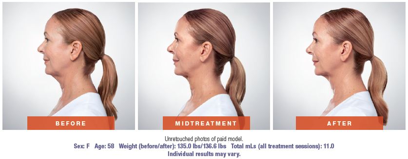 Kybella - before and after photos