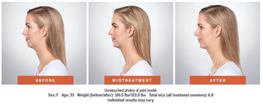 Kybella - before and after photos