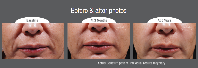 Bellafill - before and after photos