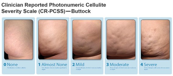 Cellulite Severity Scale