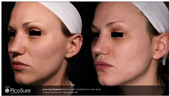 PicoSure-Treatment-for-acne-scars-before-and-after