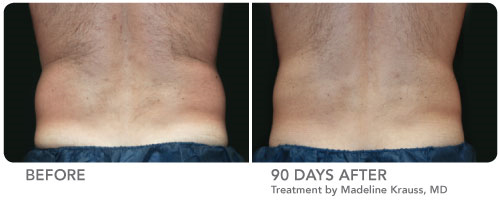 before and 90 days after coolsculpting