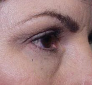 before brow lift procedure