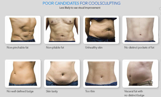 Poor candidates for Coolsculpting
