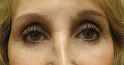 after eyelid surgery procedure