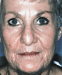 before face lift procedure at Kole Plastic Surgery Center