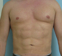 an image of male's tummy after lipo