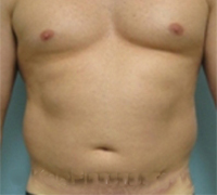 an image of male's tummy before lipo