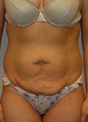 image of tummy before the procedure
