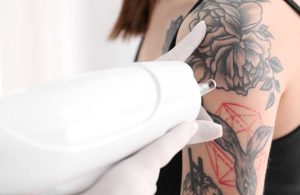 Tattoo Removal - Kole Plastic Surgery Bucks County