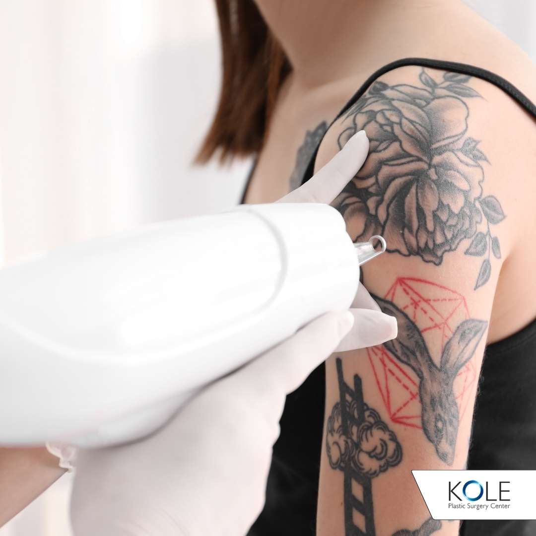 Tattoo Removal Before and After - Salmon Creek Plastic Surgery